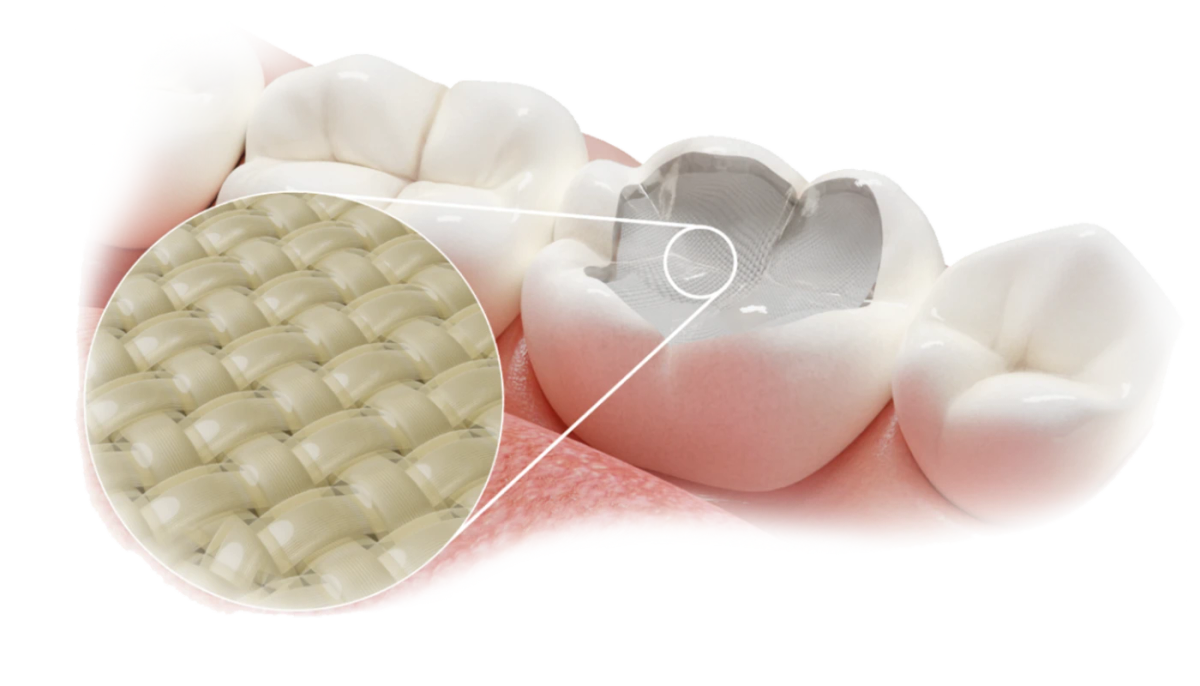 Fibrafill – ADM Dentapreg & Fibrafill, Composites