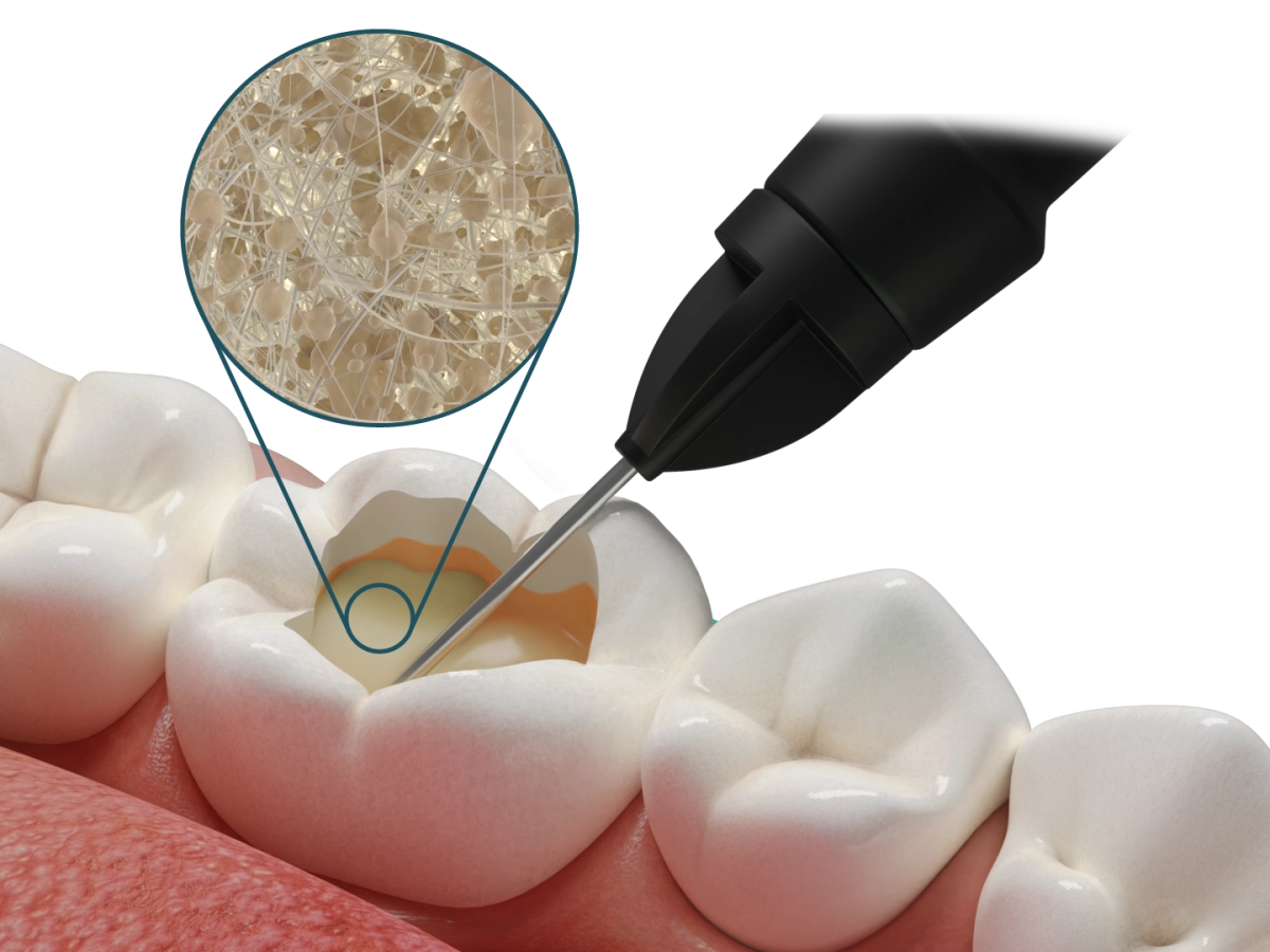 Fibrafill® FLOW – Fibrafill, Composites