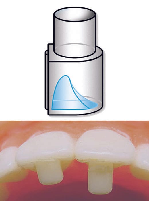 DYNAFLEX BITE-RAMP BONDER – Dynaflex Orthodontics USA, Sonstiges KFO