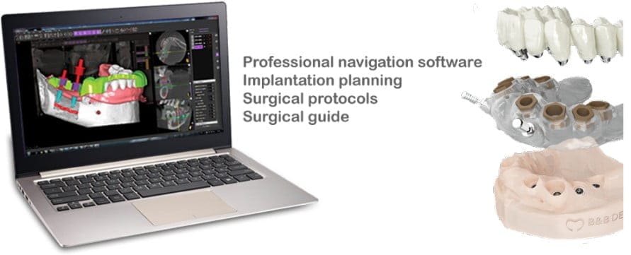 Software de cirugía guiada B&B Dental GS – B&B Dental SRL, CAD/CAM-Software