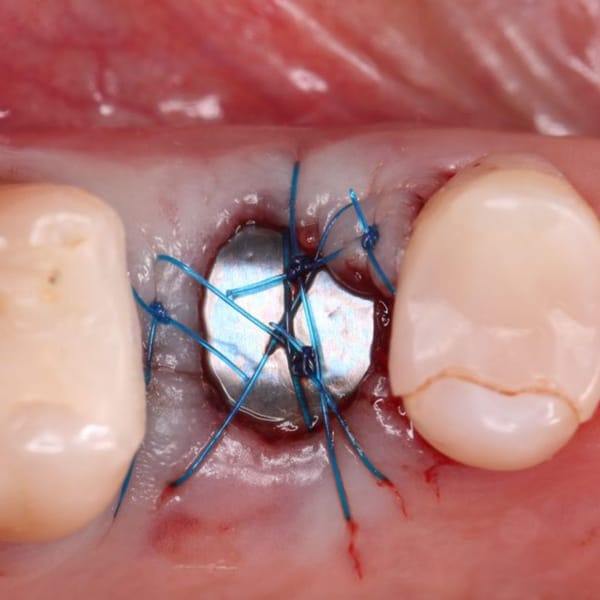 Surgitime Titanium Seal