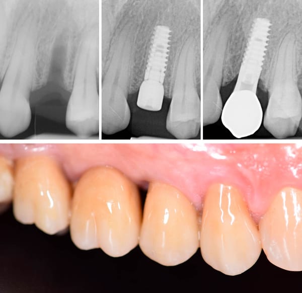 K25 Implant