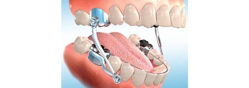 The Original Of Sleep Herbst Appliance – China Orthodontic lab, Intraorale Geräte