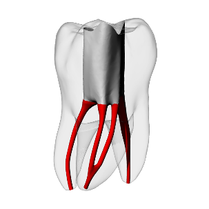 Molar – Accessed, Merging MB2, Clear, ~20#
