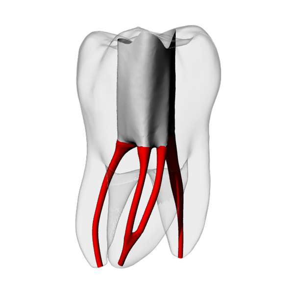 Molar – Accessed, Merging MB2, Radiopaque (White)