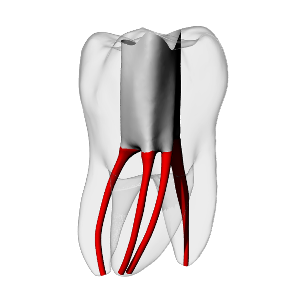 Molar – Accessed, MB2, Clear, ~20#