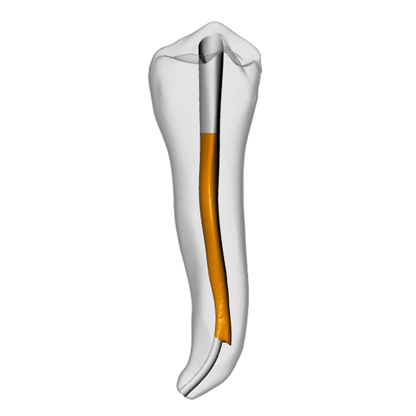 Premolar – Gutta percha, Ledge