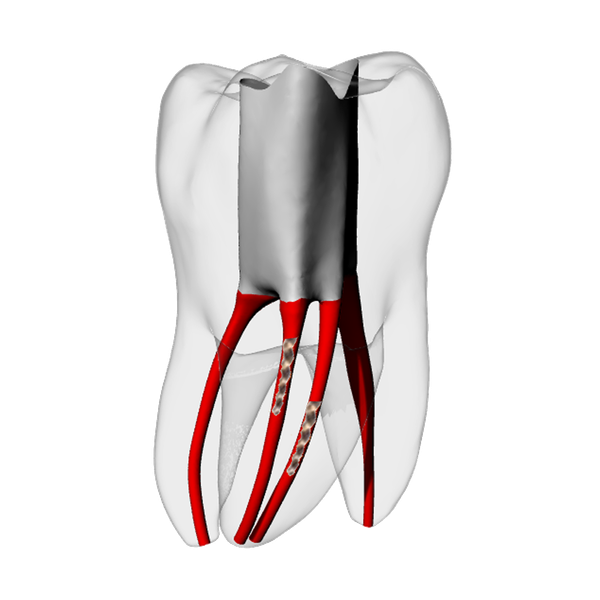 Molar – Two Broken files