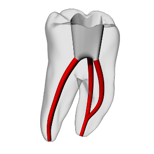 Molar – Accessed, Merging canals, Clear
