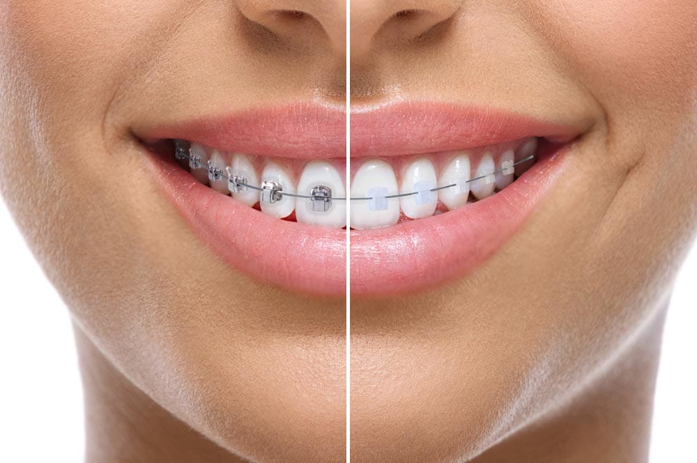 Genius System – Ortho Partner, Brackets