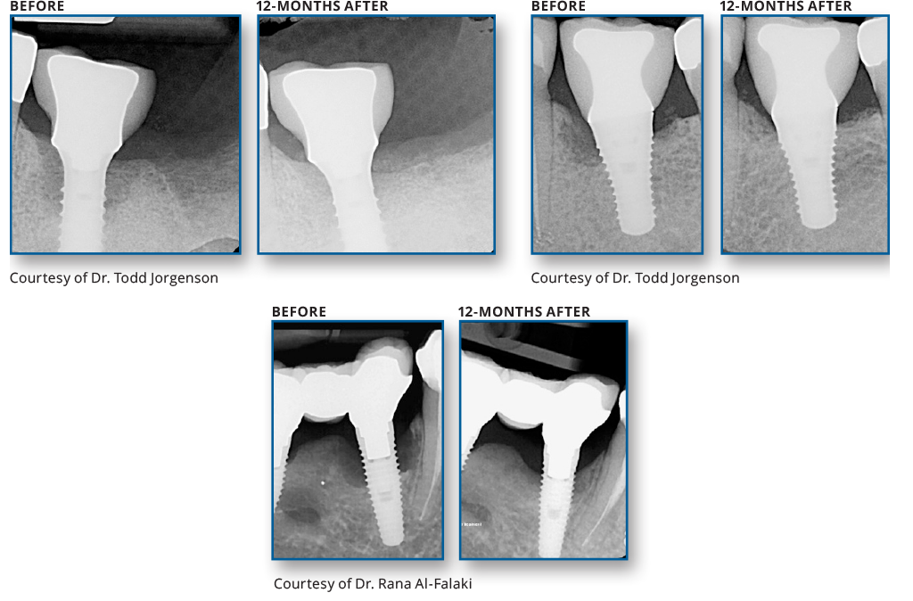 REPAIR IMPLANT™ – Biolase Technology Inc., Geräte